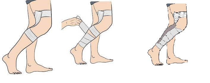 Le strapping : qu'est-ce que c'est ? Comment réaliser un bandage ?
